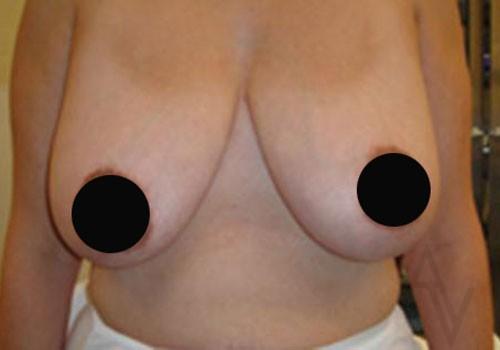 Plastic Surgery Scottsdale/Dr. Alexander Golger breast reduction result — Scottsdale, AZ
