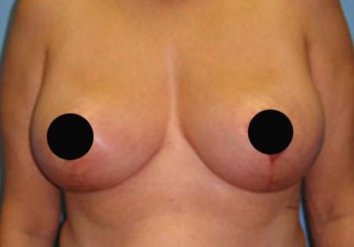 Plastic Surgery Scottsdale/Dr. Alexander Golger breast reduction result — Scottsdale, AZ