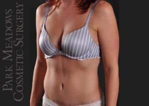 Park Meadows Cosmetic Surgery tummy tuck after — Lone Tree, CO