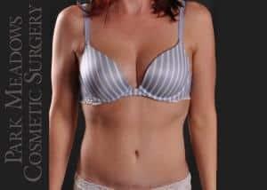 Park Meadows Cosmetic Surgery tummy tuck after — Lone Tree, CO