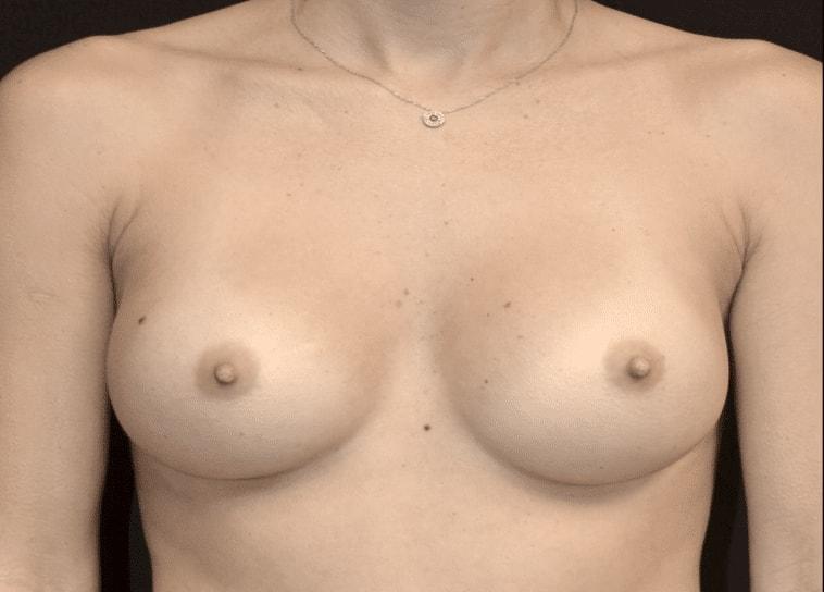 Plastic Surgery Specialists of South Florida breast augmentation after — Hollywood, FL