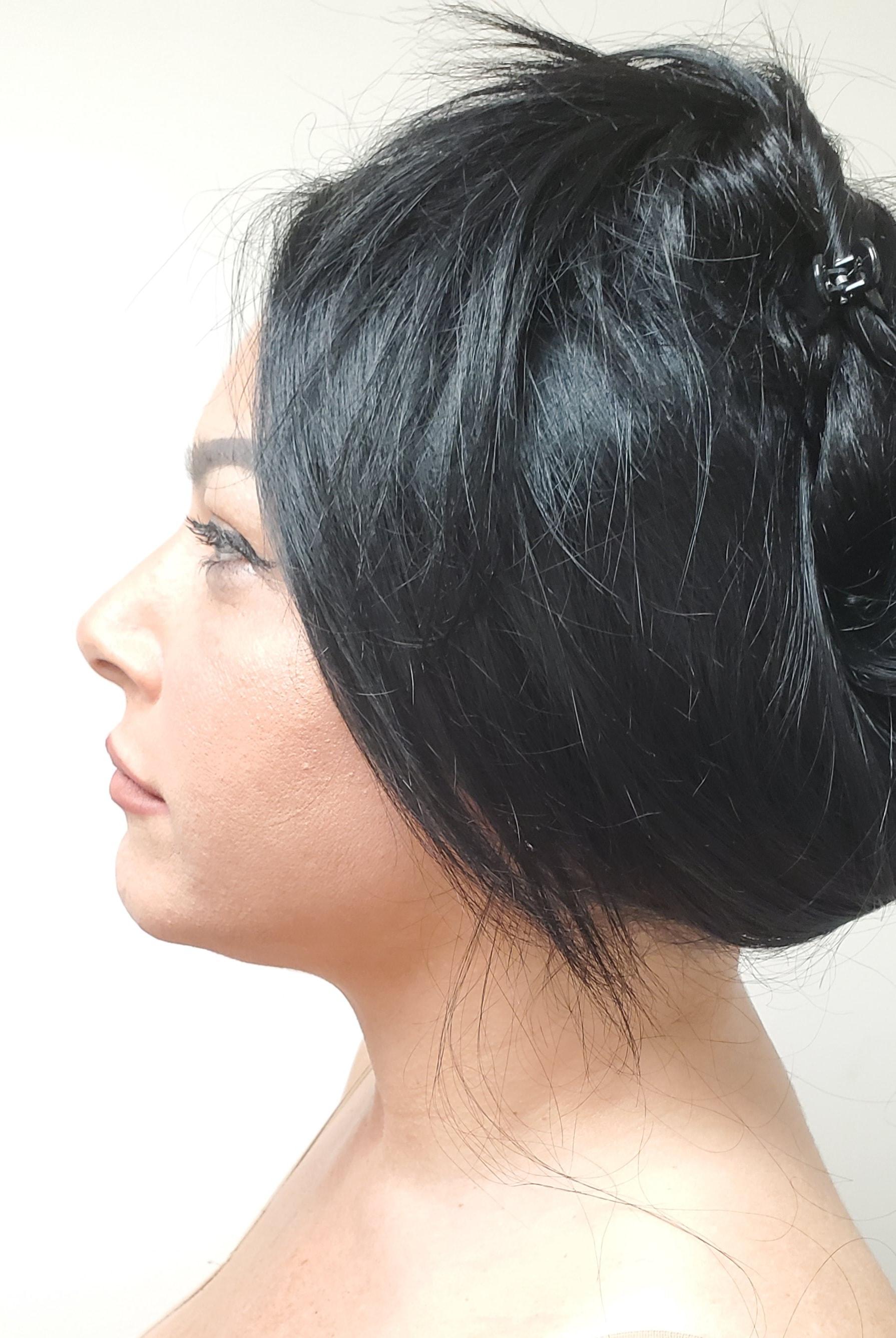 Plastic Surgery Specialists of South Florida neck lift after — Hollywood, FL