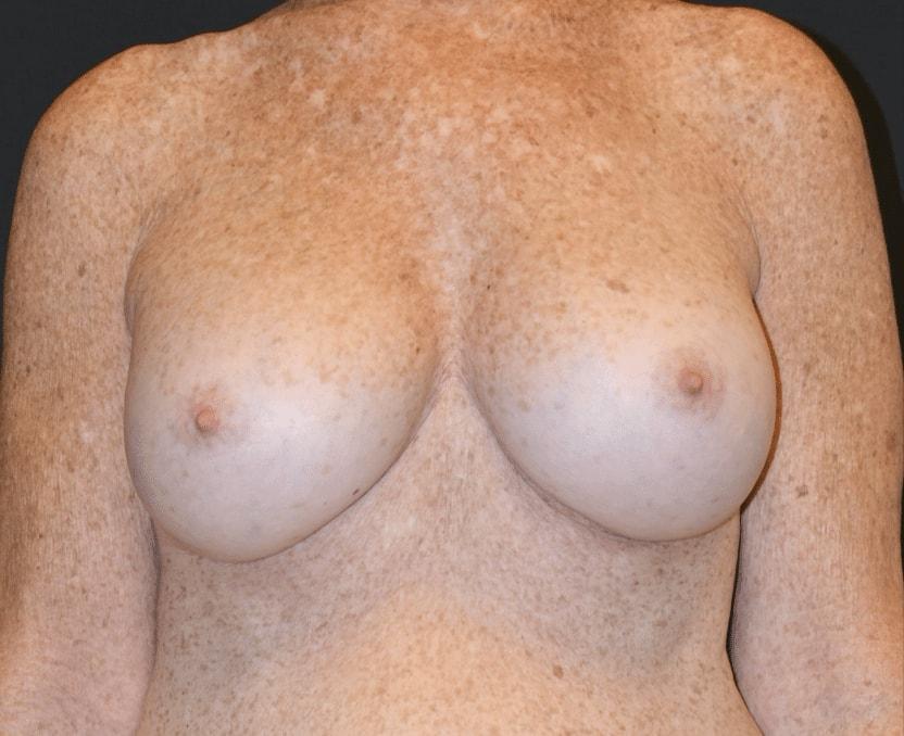 Plastic Surgery Specialists of South Florida breast augmentation after — Hollywood, FL