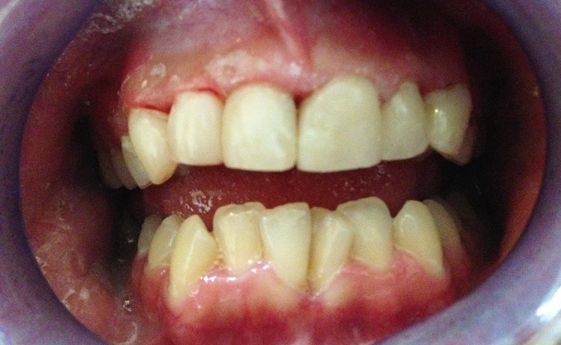 New Concepts Dentistry veneers after — Bountiful, UT