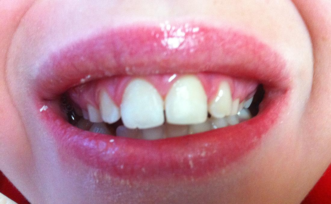 New Concepts Dentistry veneers after — Bountiful, UT