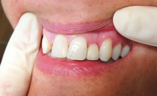 Dental Crowns before at New Concepts Dentistry in Bountiful, UT