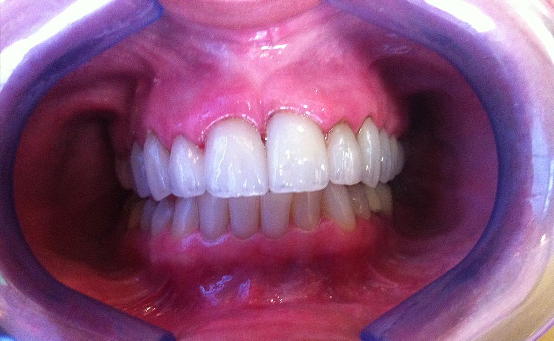 New Concepts Dentistry veneers after — Bountiful, UT