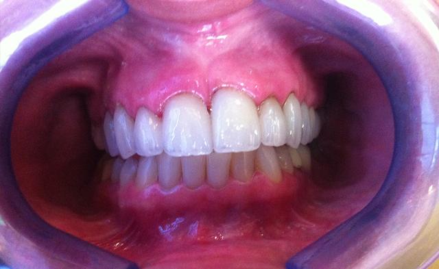 Dental Veneers after at New Concepts Dentistry in Bountiful, UT