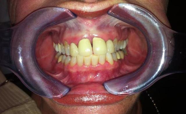 Dental Veneers before at New Concepts Dentistry in Bountiful, UT