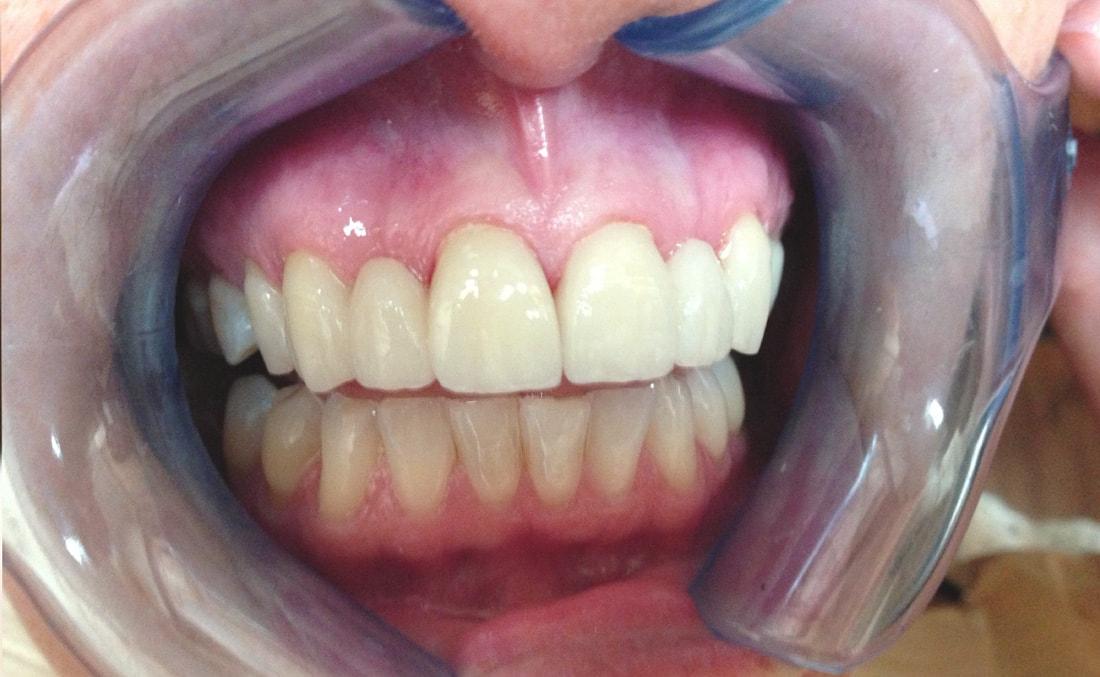 New Concepts Dentistry dental crowns after — Bountiful, UT