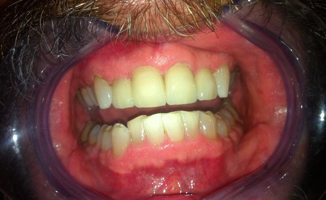 New Concepts Dentistry veneers after — Bountiful, UT