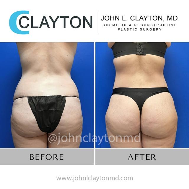 Liposuction result at John L Clayton MD in Cottonwood Heights, UT