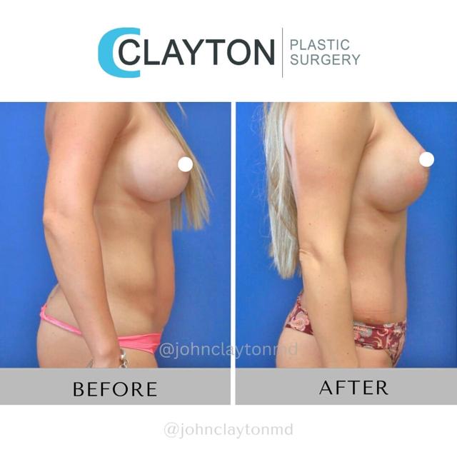 Mini Tummy Tuck result at John L Clayton MD in Cottonwood Heights, UT