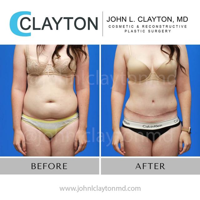 Liposuction result at John L Clayton MD in Cottonwood Heights, UT