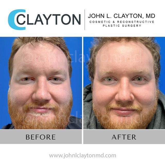 Blepharoplasty result at John L Clayton MD in Cottonwood Heights, UT