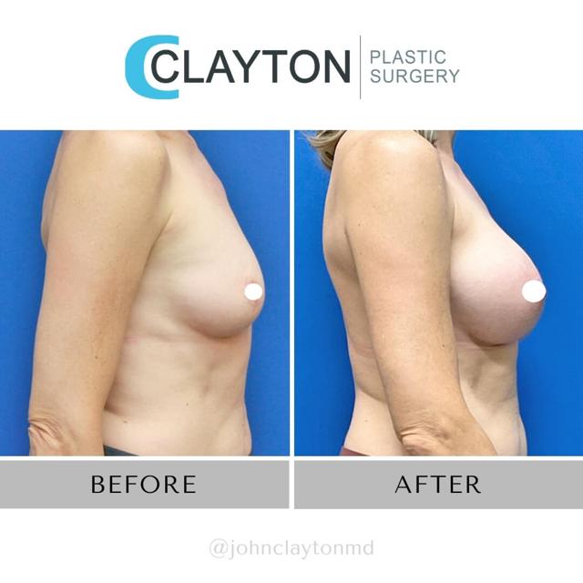 Fat Transfer Breast Augmentation result at John L Clayton MD in Cottonwood Heights, UT