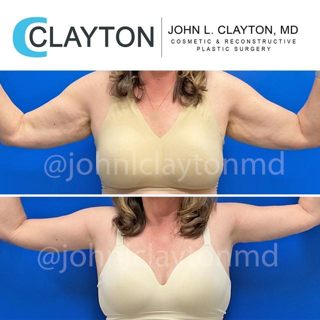 Arm Lift result at John L Clayton MD in Cottonwood Heights, UT