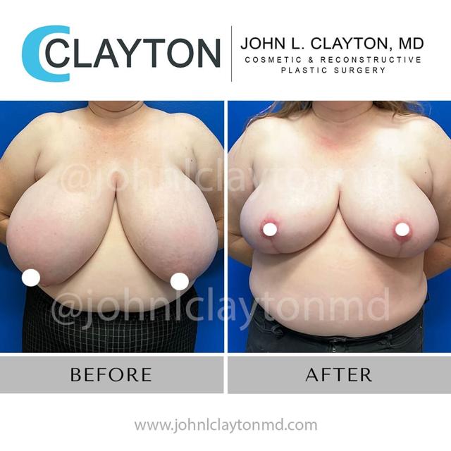 Breast Reduction result at John L Clayton MD in Cottonwood Heights, UT