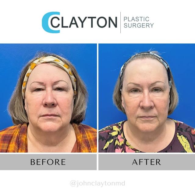 Blepharoplasty result at John L Clayton MD in Cottonwood Heights, UT