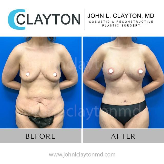 Mommy Makeover result at John L Clayton MD in Cottonwood Heights, UT