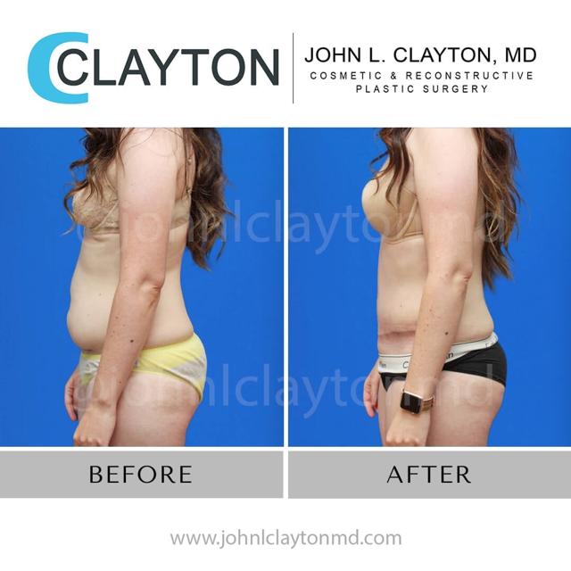 Liposuction result at John L Clayton MD in Cottonwood Heights, UT