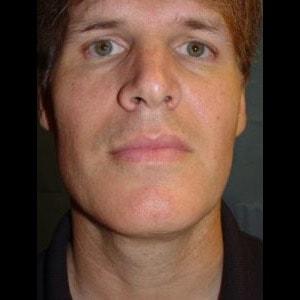 Gladstone Clinic neck liposuction after — Danville, CA