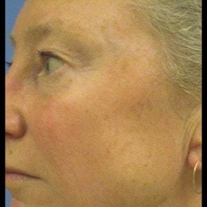 Gladstone Clinic laser treatment after — Danville, CA