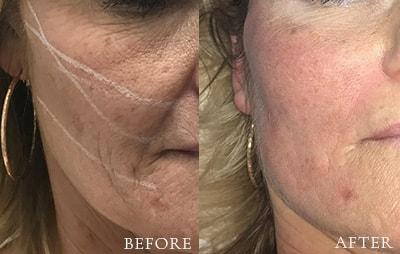 Xage Medical Spa thread lift result — Provo, UT