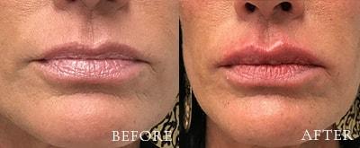 Xage Medical Spa lip filler result — Provo, UT