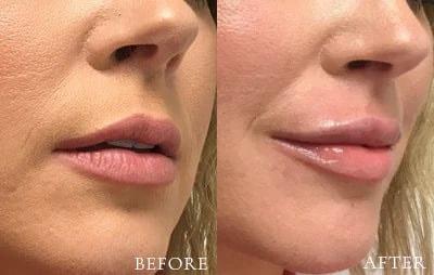 Xage Medical Spa lip filler result — Provo, UT