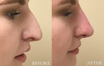 Xage Medical Spa result — Provo, UT