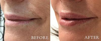 Xage Medical Spa lip filler result — Provo, UT