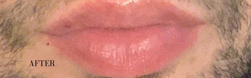 Ferzli Facial Plastic Surgery lip filler after — New York, NY