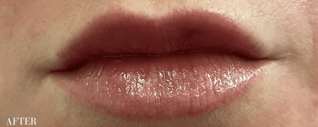 Ferzli Facial Plastic Surgery lip filler after — New York, NY