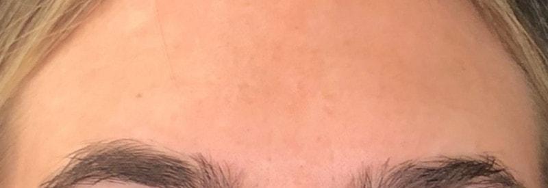 Ferzli Facial Plastic Surgery botox after — New York, NY