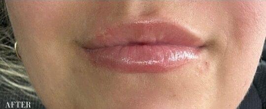 Ferzli Facial Plastic Surgery lip filler after — New York, NY