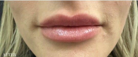 Ferzli Facial Plastic Surgery lip filler after — New York, NY
