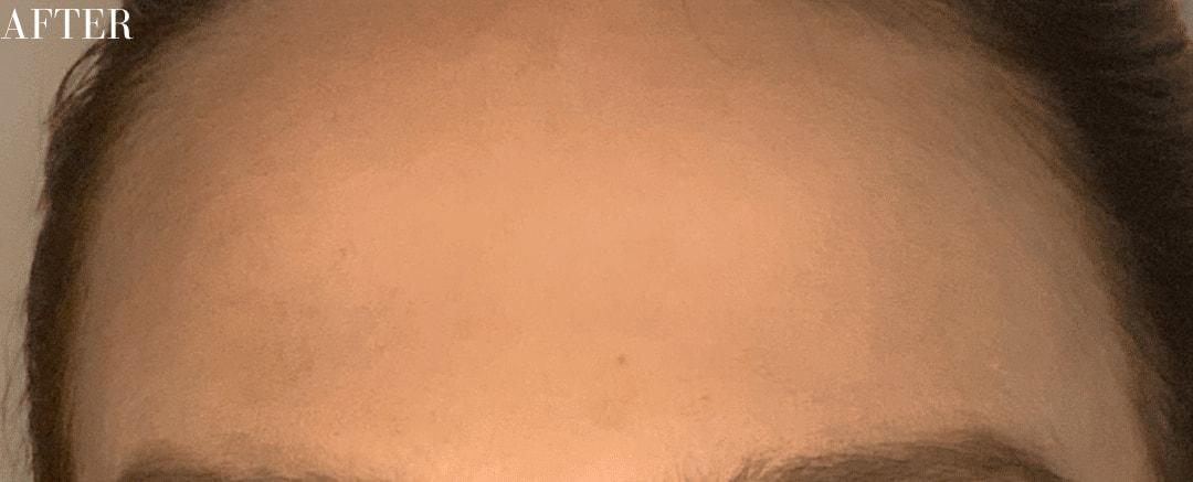 Ferzli Facial Plastic Surgery botox after — New York, NY