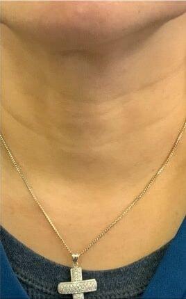 Ferzli Facial Plastic Surgery botox after — New York, NY