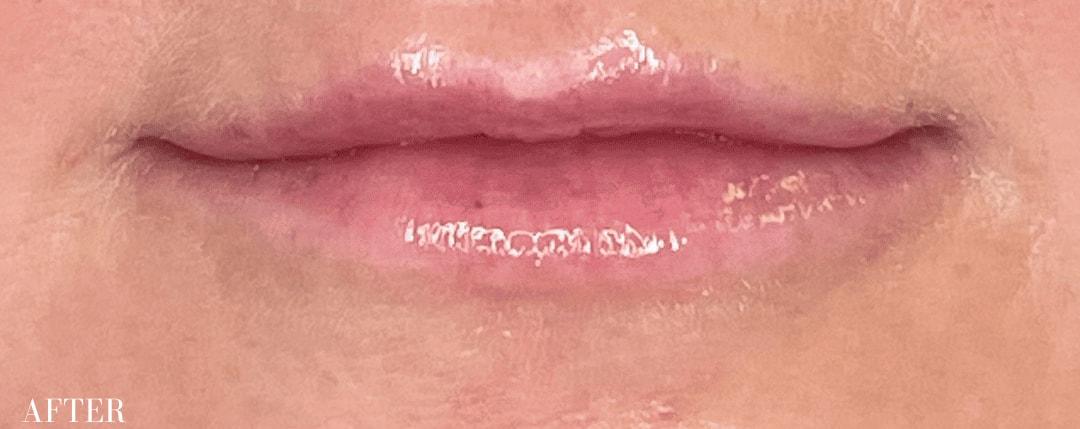 Ferzli Facial Plastic Surgery lip filler after — New York, NY