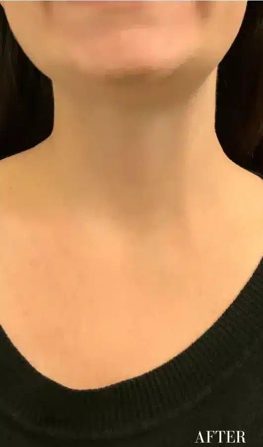 Ferzli Facial Plastic Surgery botox after — New York, NY