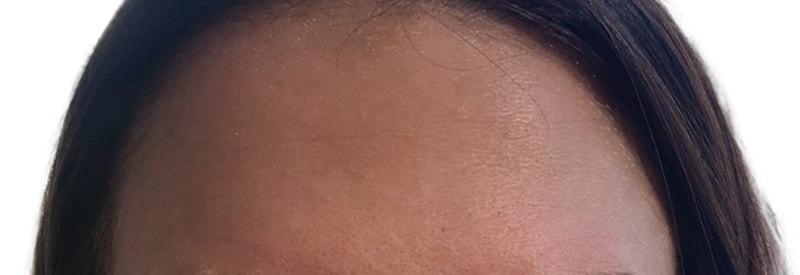 Ferzli Facial Plastic Surgery botox after — New York, NY