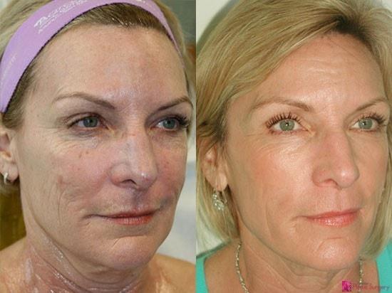 James Newman, MD laser treatment result — Palo Alto, CA