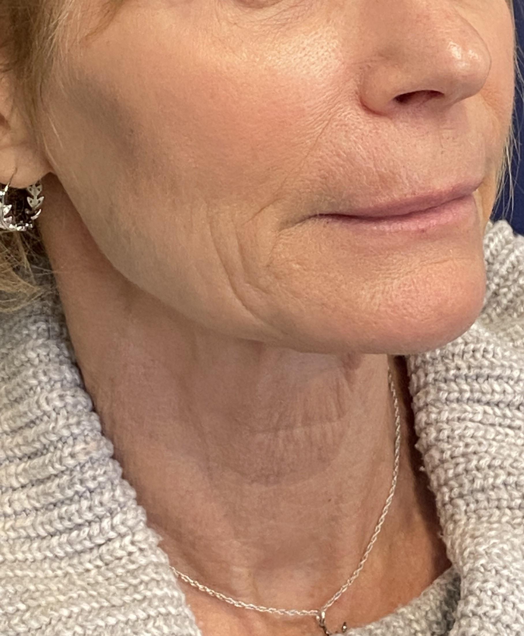 James Newman, MD skin tightening after — Palo Alto, CA