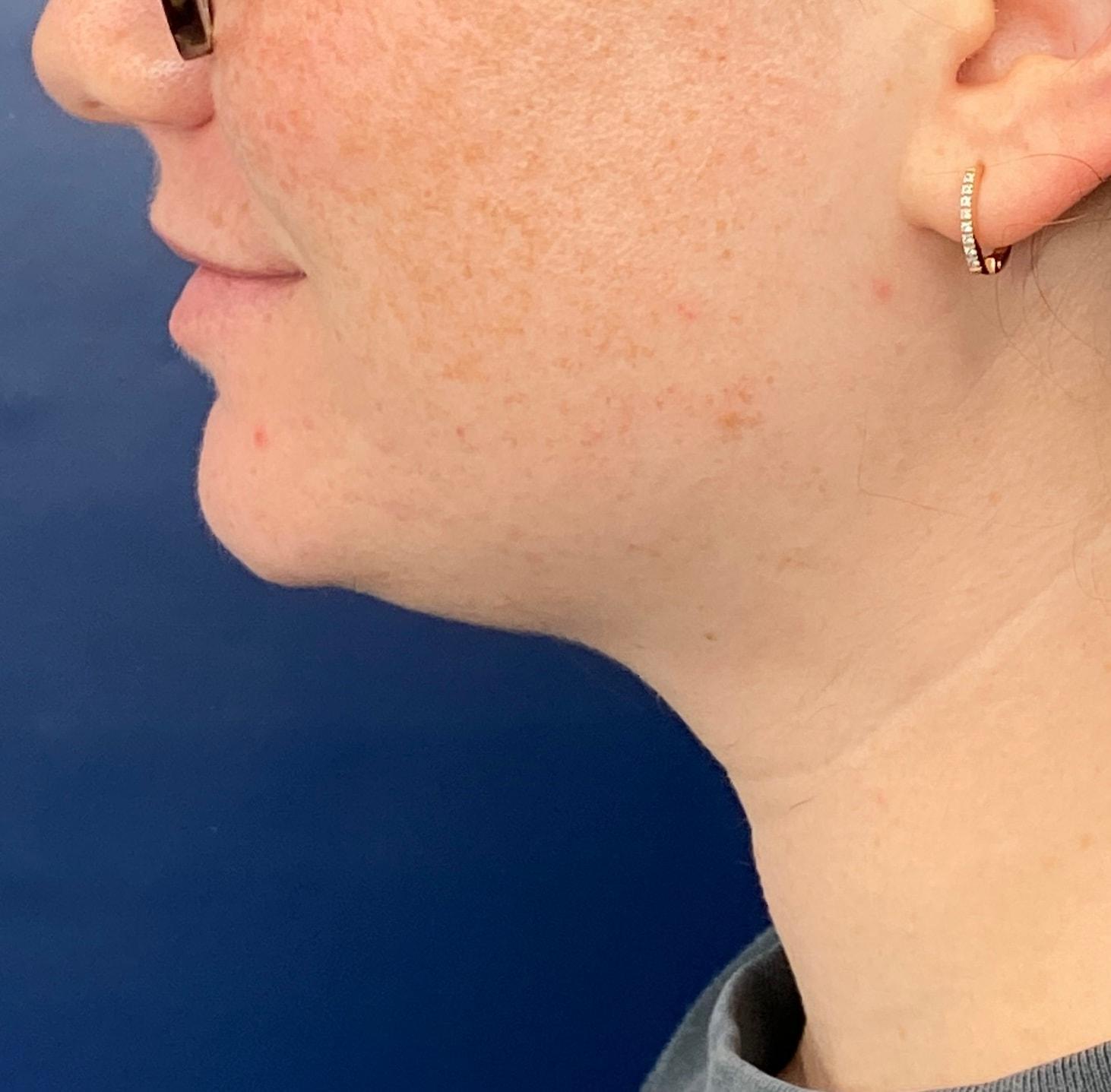 James Newman, MD skin tightening after — Palo Alto, CA