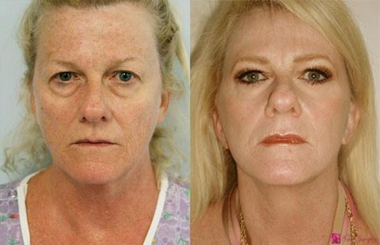 James Newman, MD laser treatment result — Palo Alto, CA