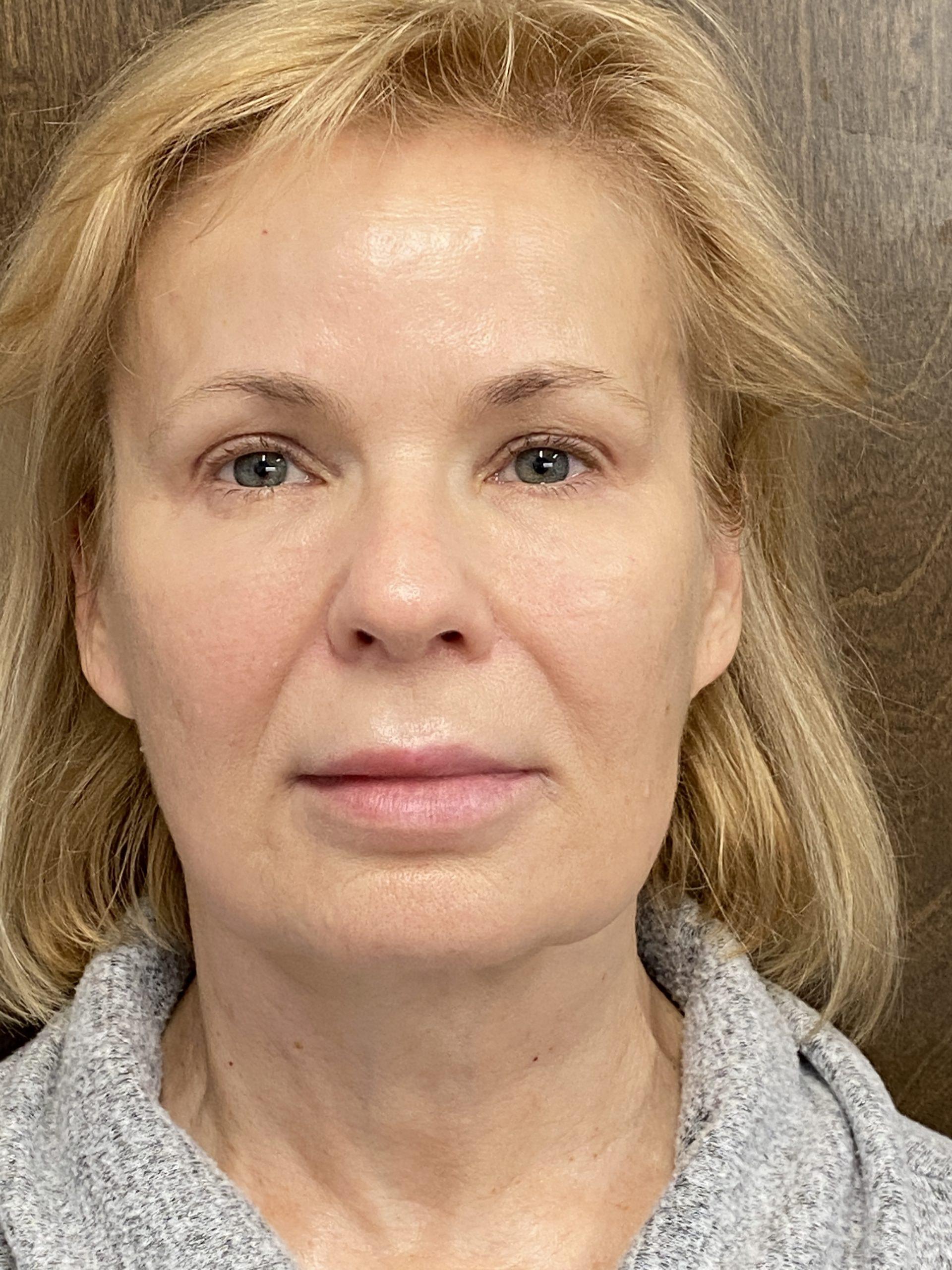 James Newman, MD thread lift after — Palo Alto, CA