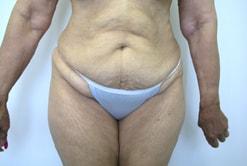 Tummy Tuck before at The Art of Plastic Surgery (Gregory A. Wiener, MD) in Chicago, IL