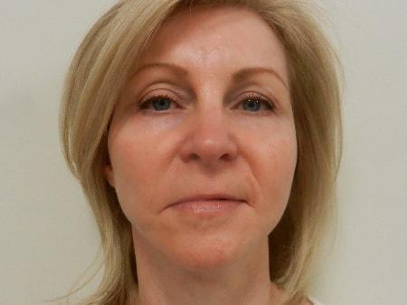 Brow Lift after at The Art of Plastic Surgery (Gregory A. Wiener, MD) in Chicago, IL