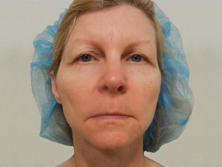 Brow Lift before at The Art of Plastic Surgery (Gregory A. Wiener, MD) in Chicago, IL